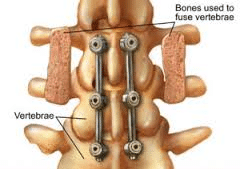 Spinal Fusion New Jersey | Spine Surgery NJ 