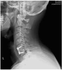 Cervical fusion x-ray