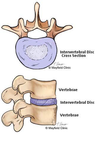 DiagnosisDiscogenicBackPain