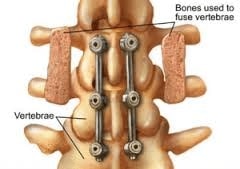 illustration of spinal fusion showing bones fused to vertebrae