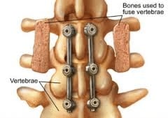 spinal fusion