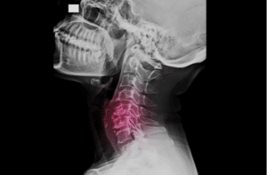cervical spine x ray showing multiple degenerative spondylosis causing neck pain and myelopathy.