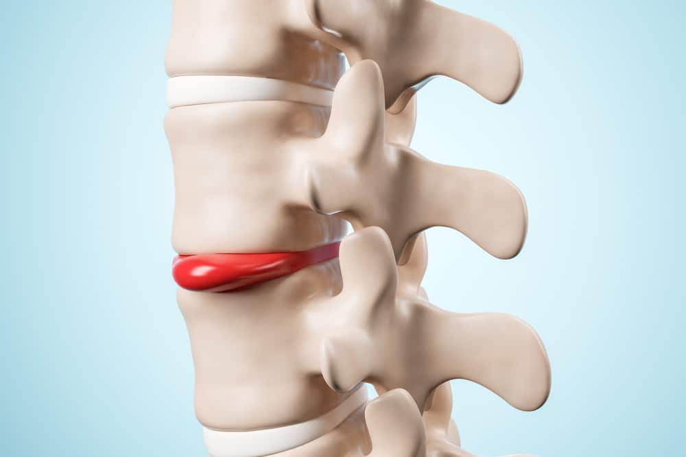 Human,Spinal,Intervertebrael,Hernia.,Disk,Spain,Degradation.,3d,Rendering.